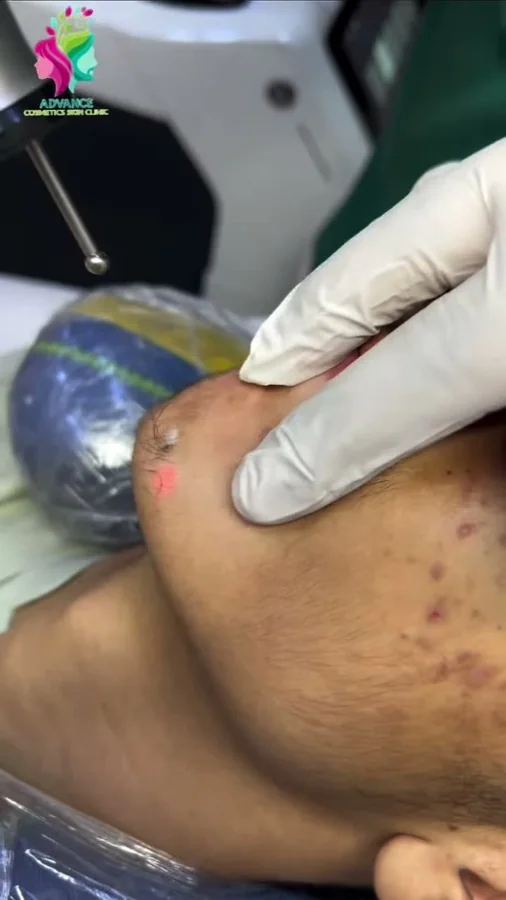 Acne, scars and skin resurfacing