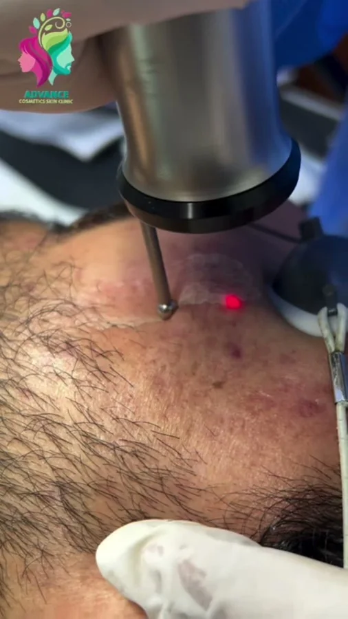 Acne, scars and skin resurfacing