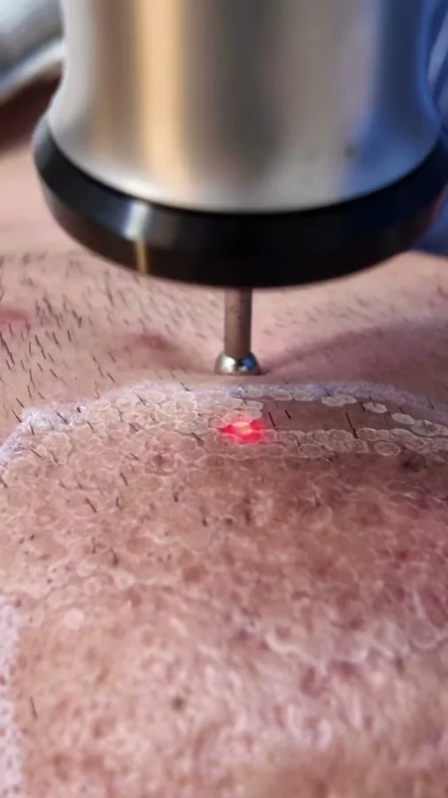 Acne, scars and skin resurfacing