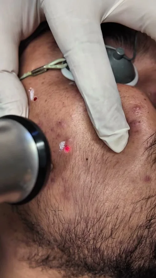 Acne, scars and skin resurfacing