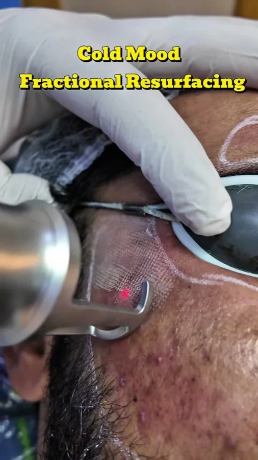 Acne, scars and skin resurfacing