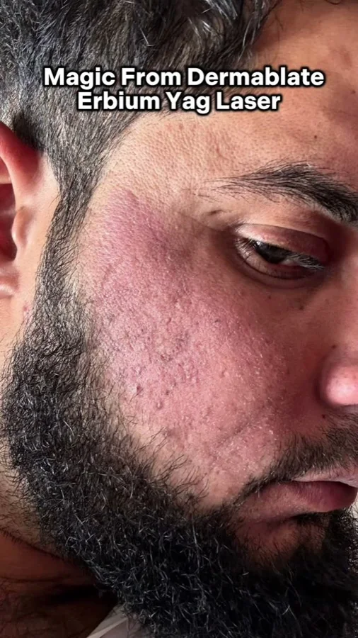 Acne, scars and skin resurfacing