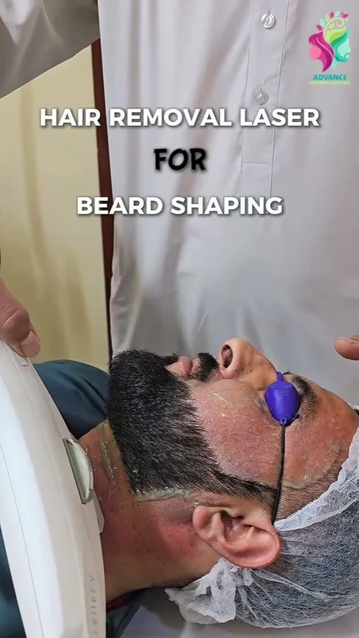 Laser beard-line shaping