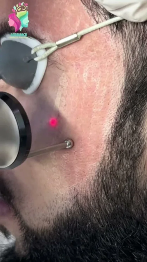 Laser beard-line shaping