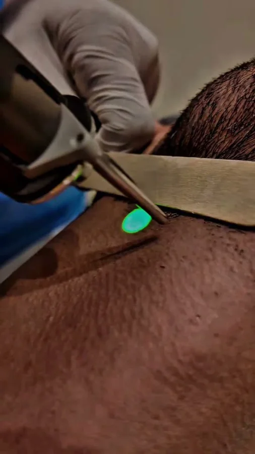 Laser beard-line shaping