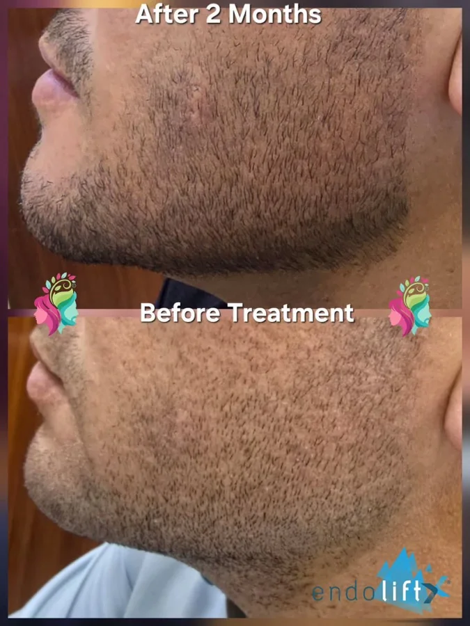 Body contouring, slimming and double chin