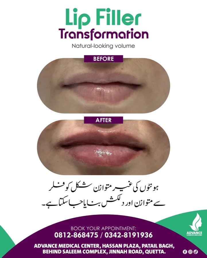 Botox and dermal fillers