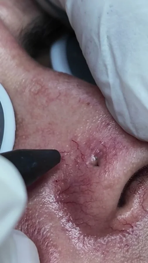 Pigmentation, melasma and freckles