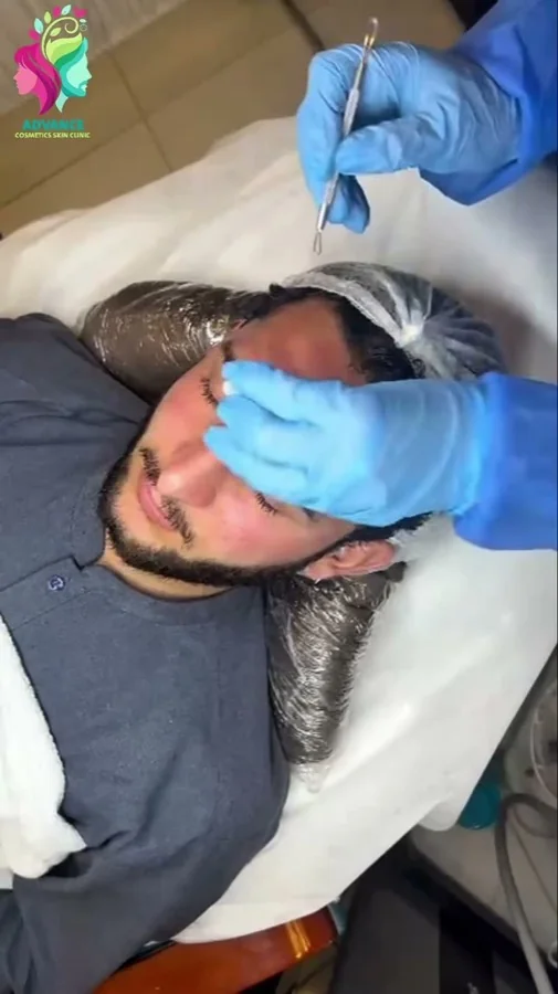 HydraFacial, carbon peel and beauty services