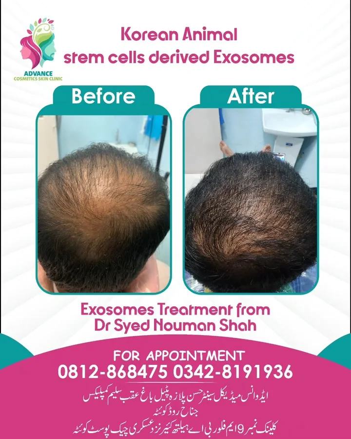 Hair fall and hair restoration