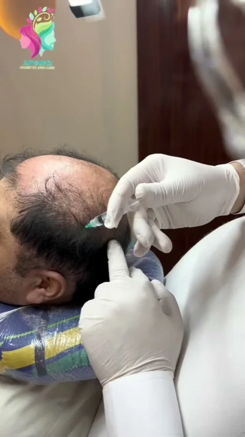 Hair fall and hair restoration
