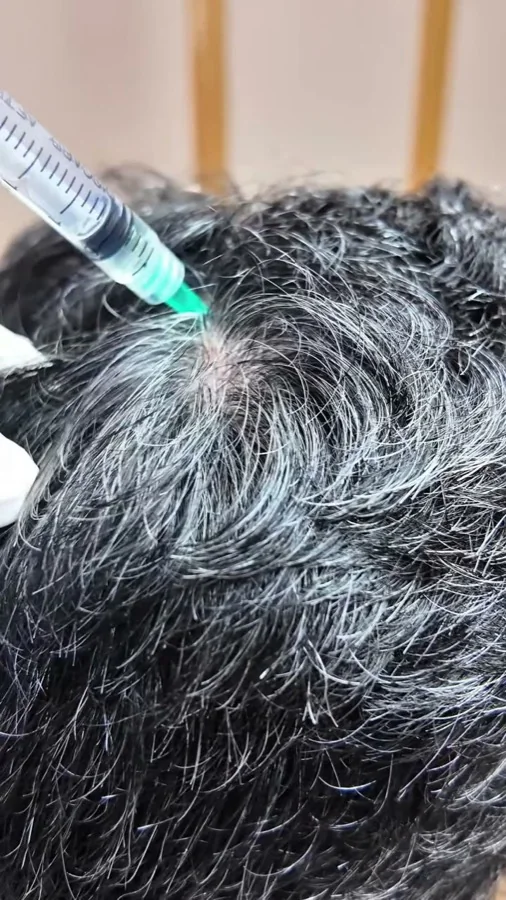 Hair fall and hair restoration