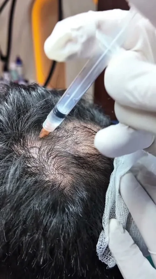 Hair fall and hair restoration