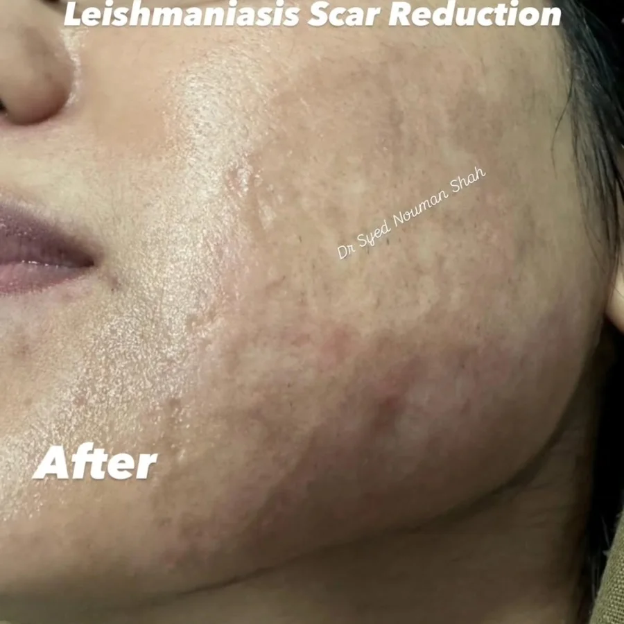 Acne, scars and skin resurfacing