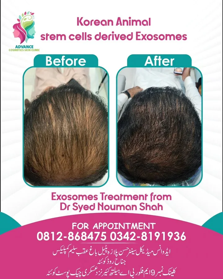 Hair fall and hair restoration