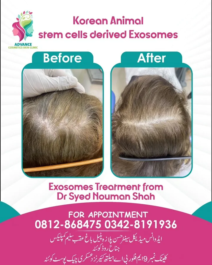 Hair fall and hair restoration