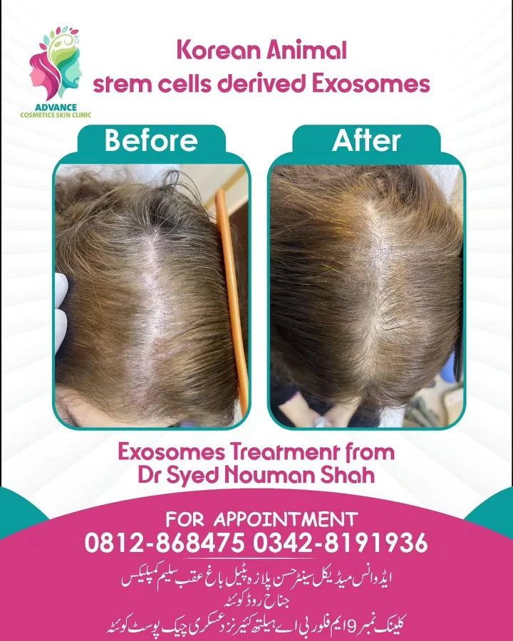Hair fall and hair restoration
