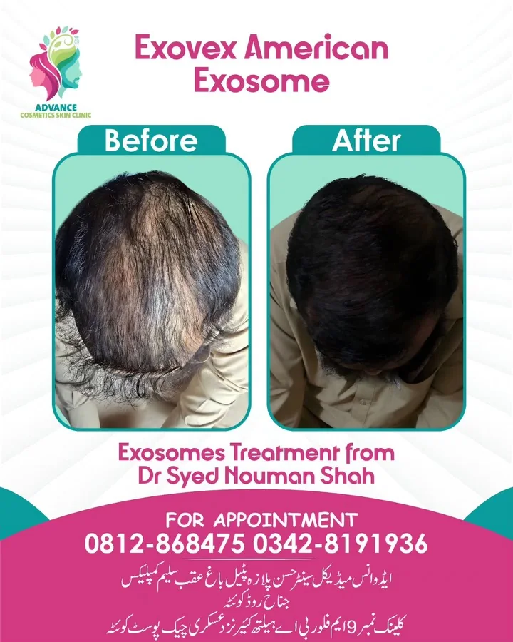 Hair fall and hair restoration