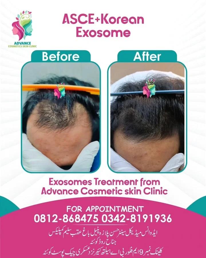 Hair fall and hair restoration