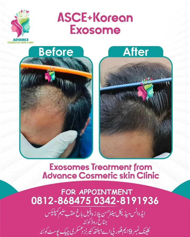 Hair fall and hair restoration