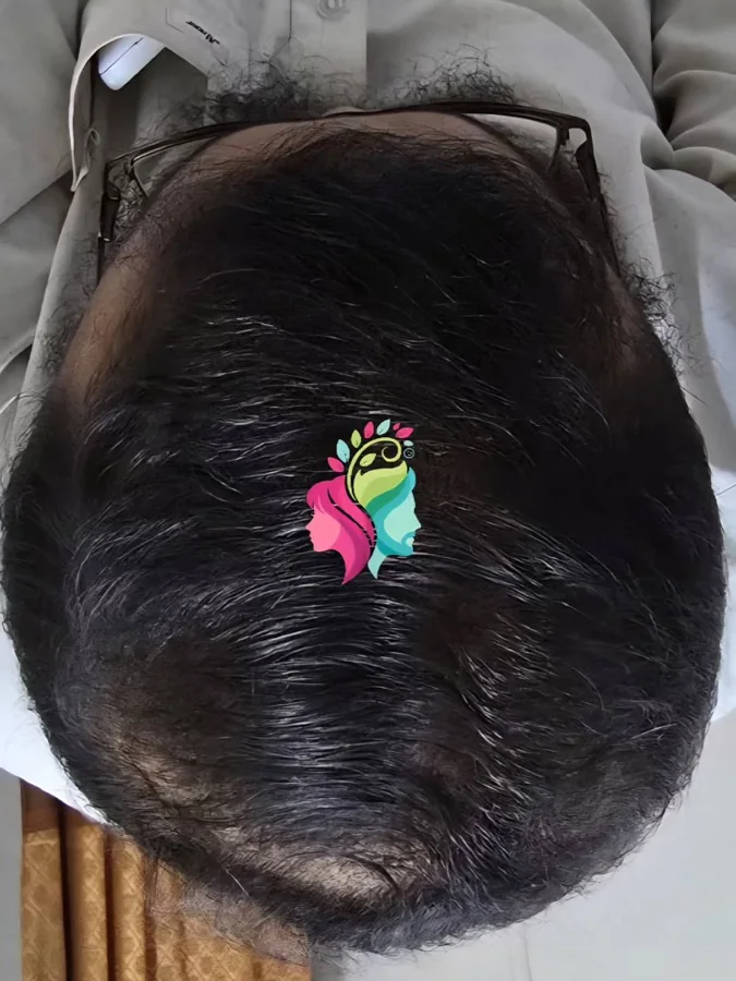Hair fall and hair restoration