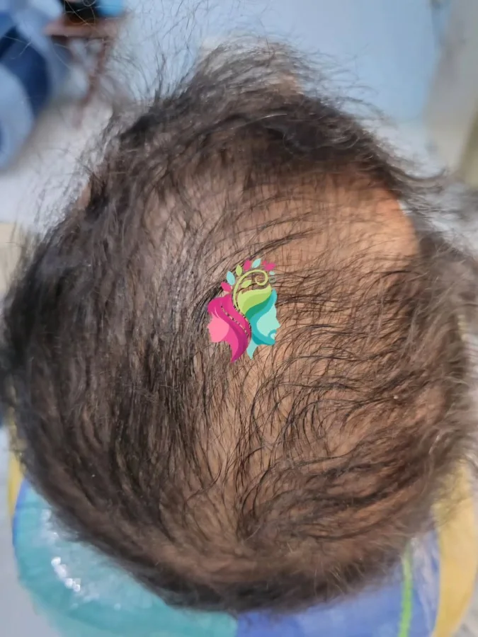 Hair fall and hair restoration