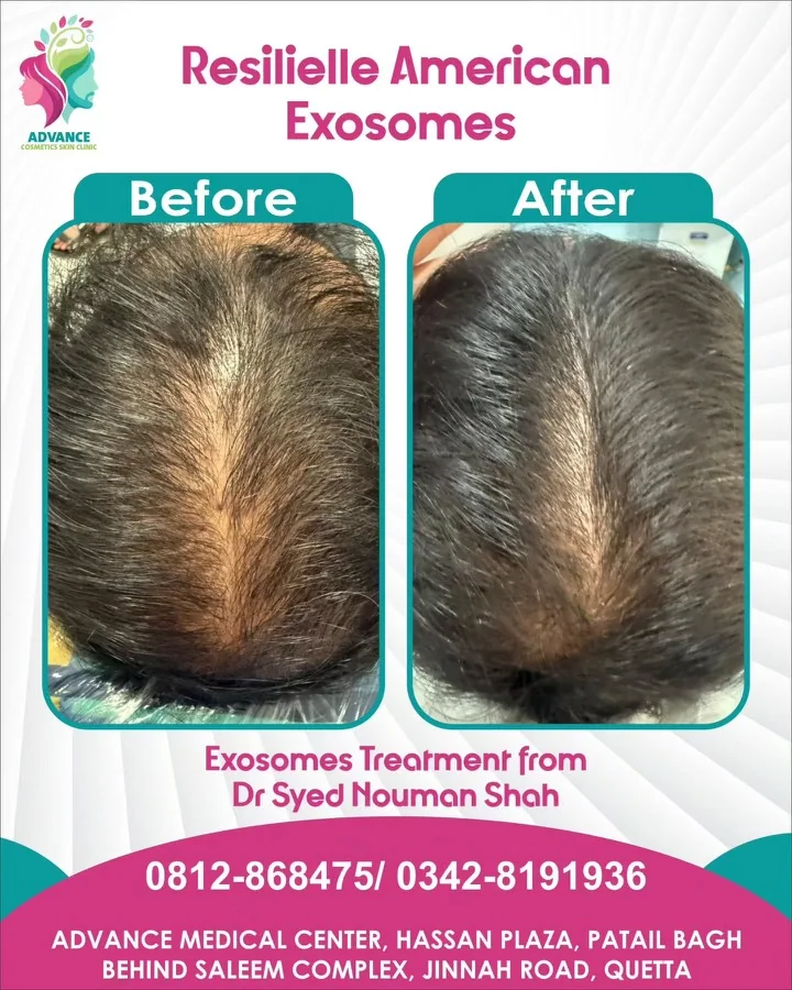 Hair fall and hair restoration