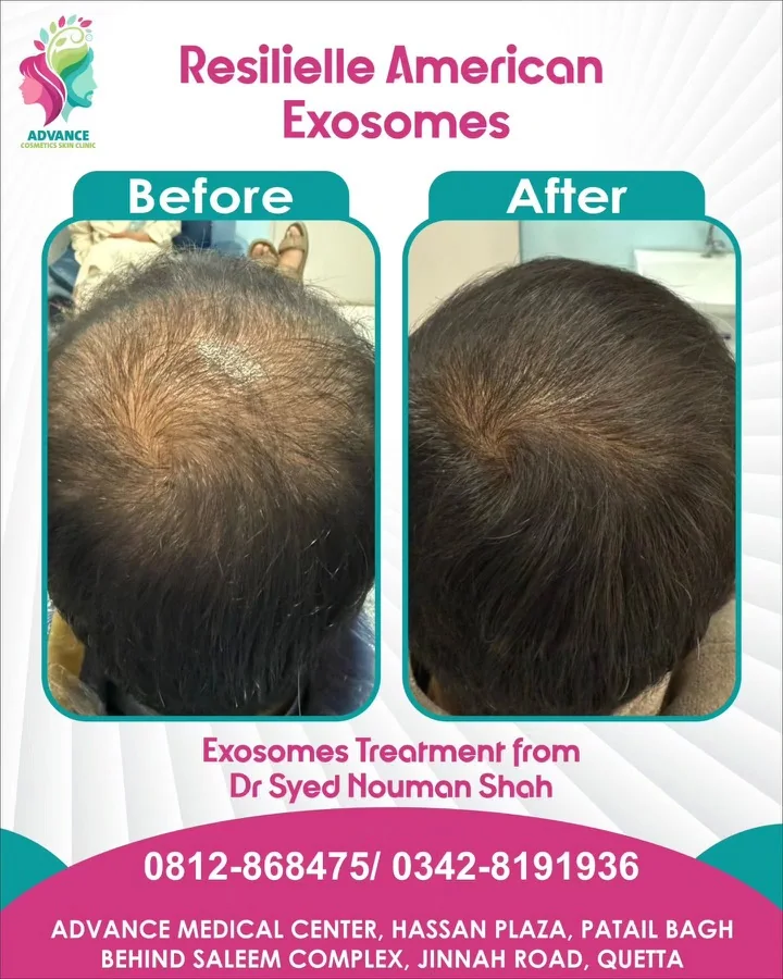 Hair fall and hair restoration