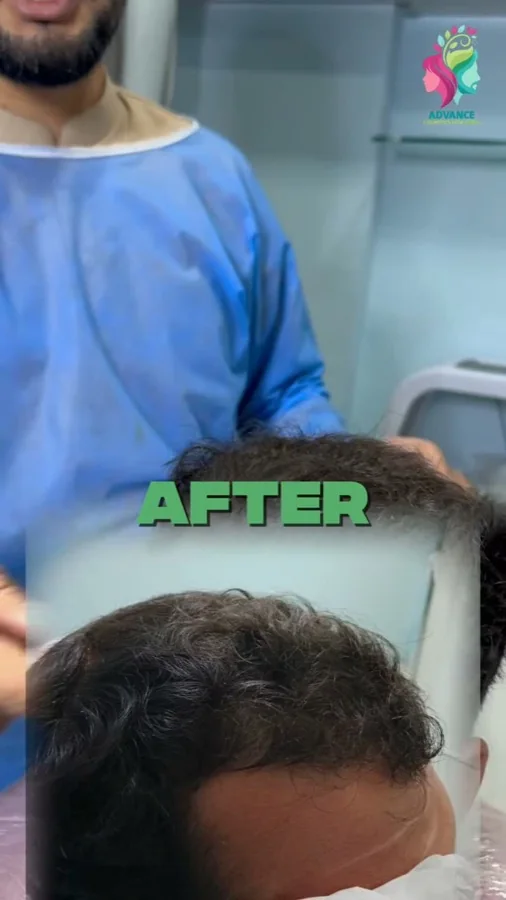 Hair fall and hair restoration