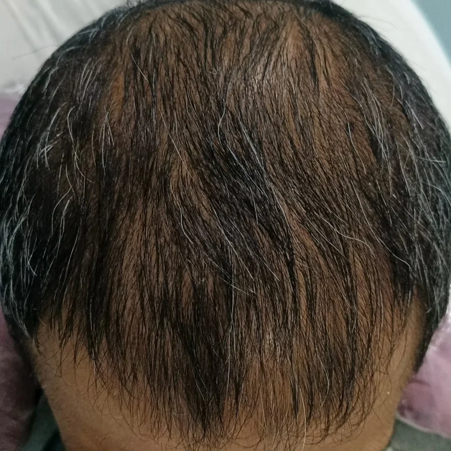 Hair fall and hair restoration
