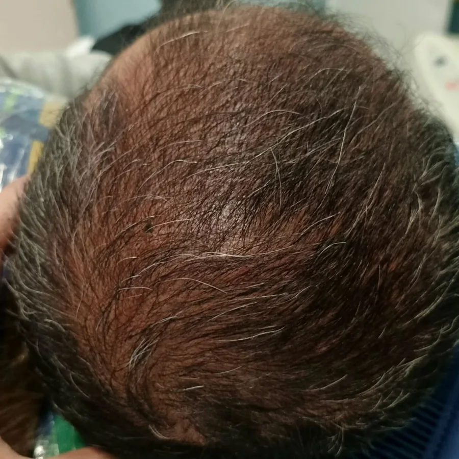 Hair fall and hair restoration
