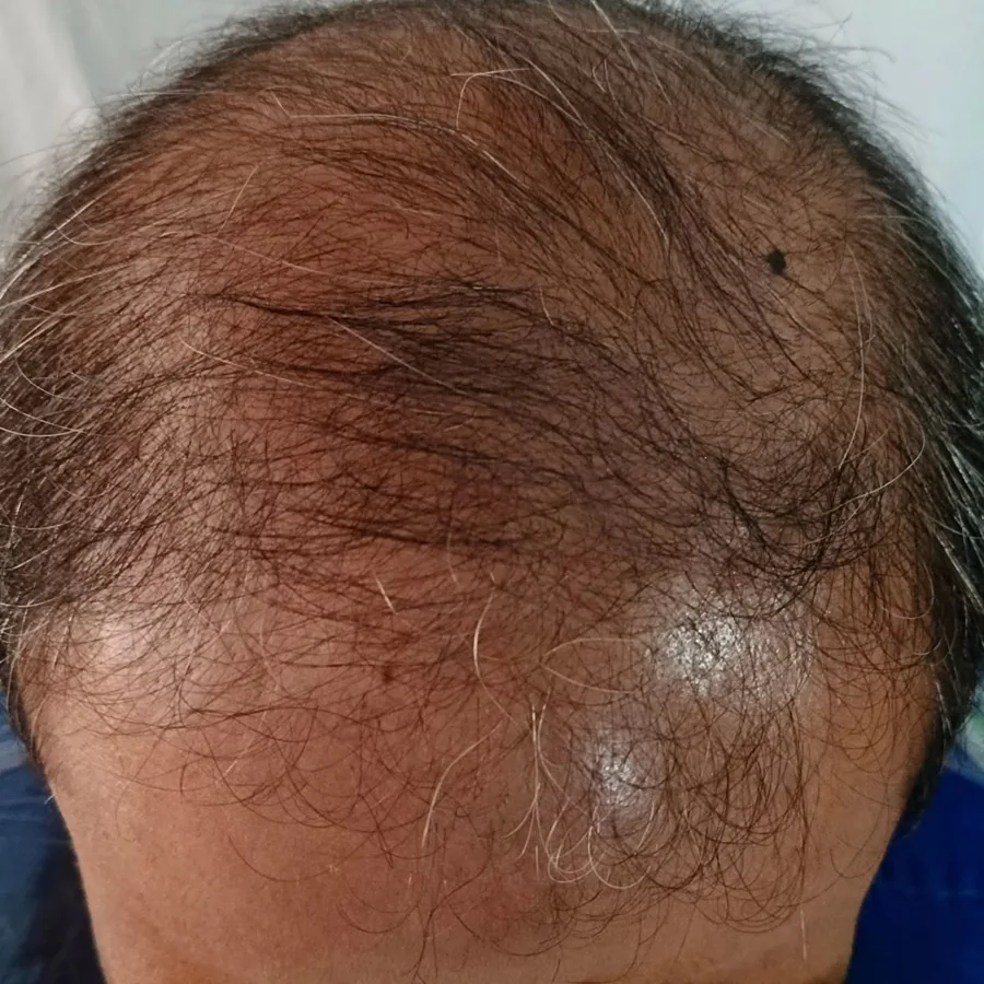 Hair fall and hair restoration