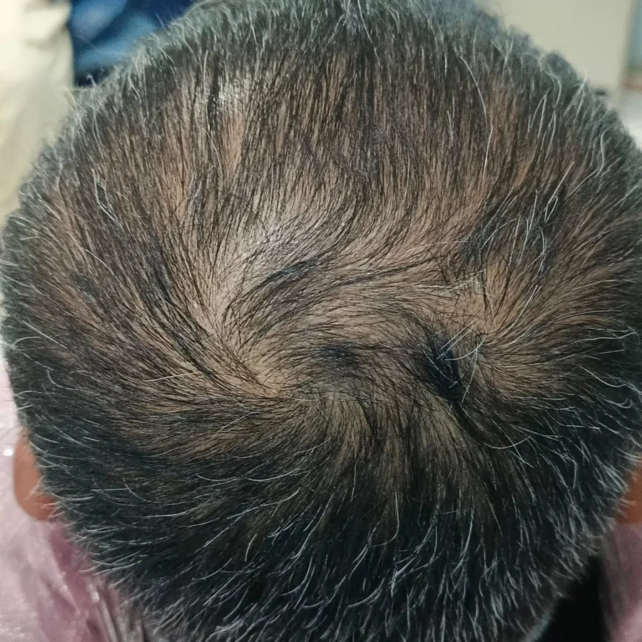Hair fall and hair restoration