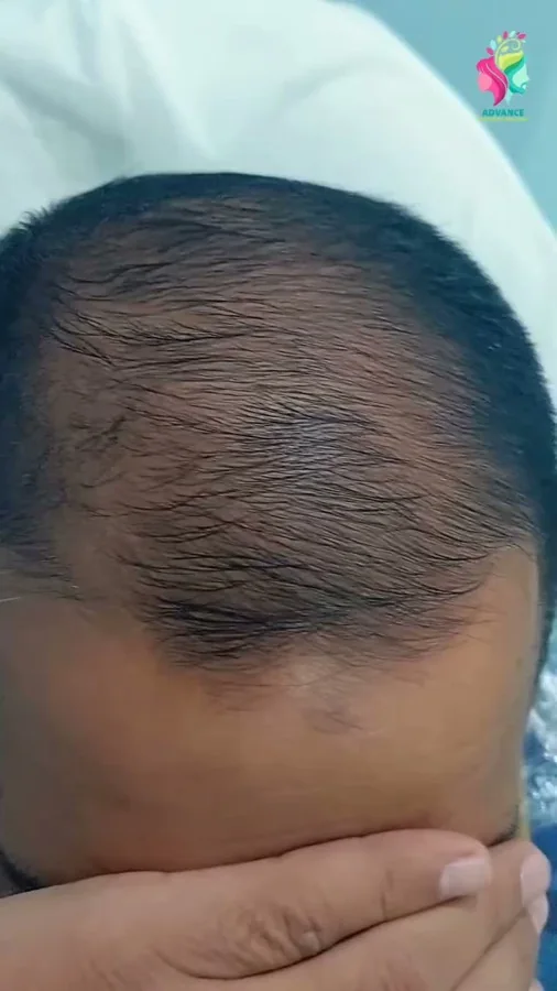 Hair fall and hair restoration