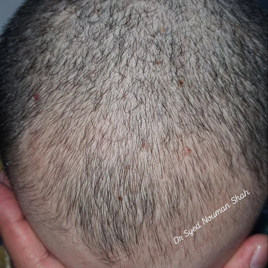 Hair fall and hair restoration