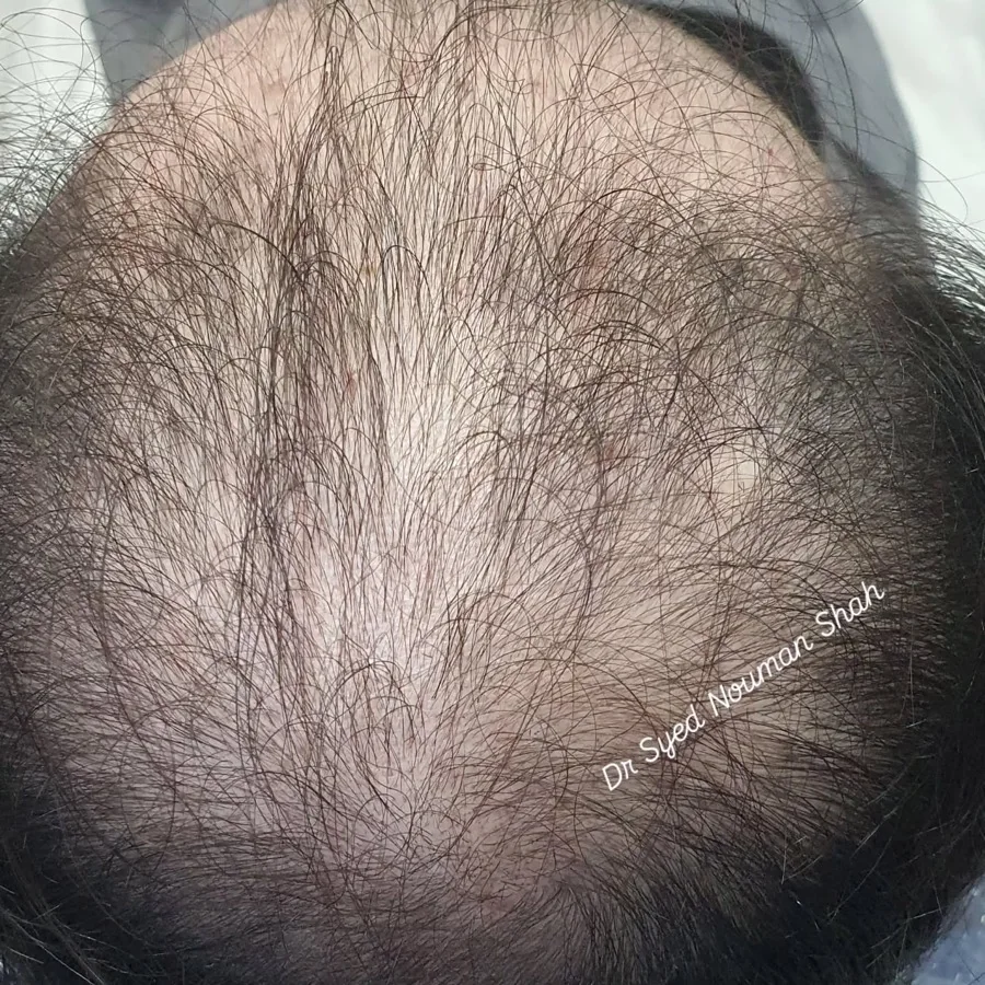 Hair fall and hair restoration