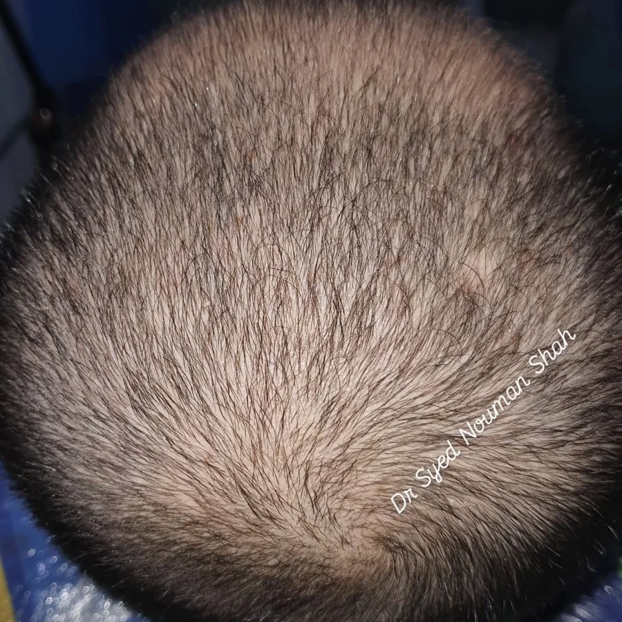 Hair fall and hair restoration