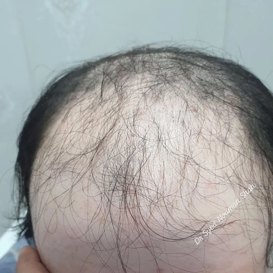 Hair fall and hair restoration