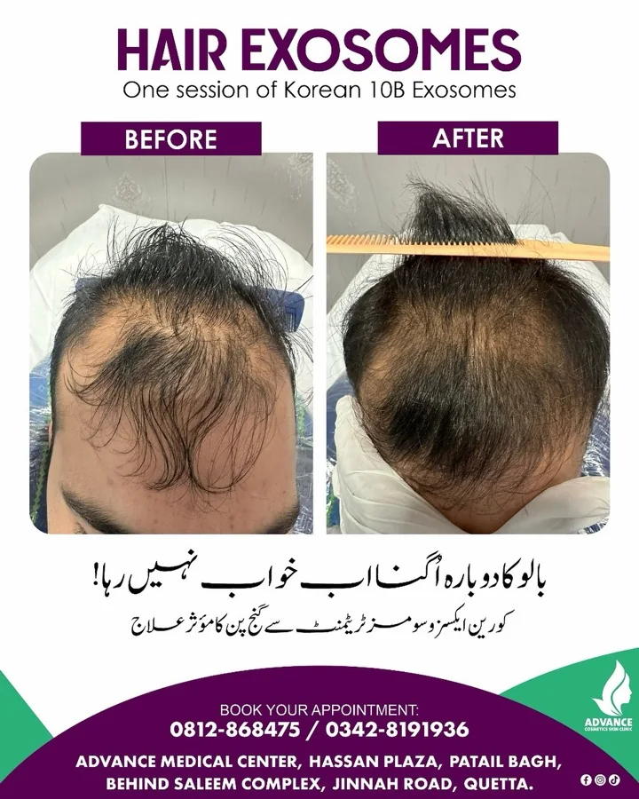 Hair fall and hair restoration