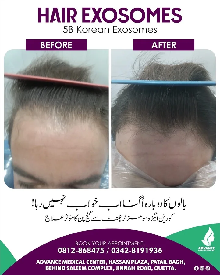 Hair fall and hair restoration