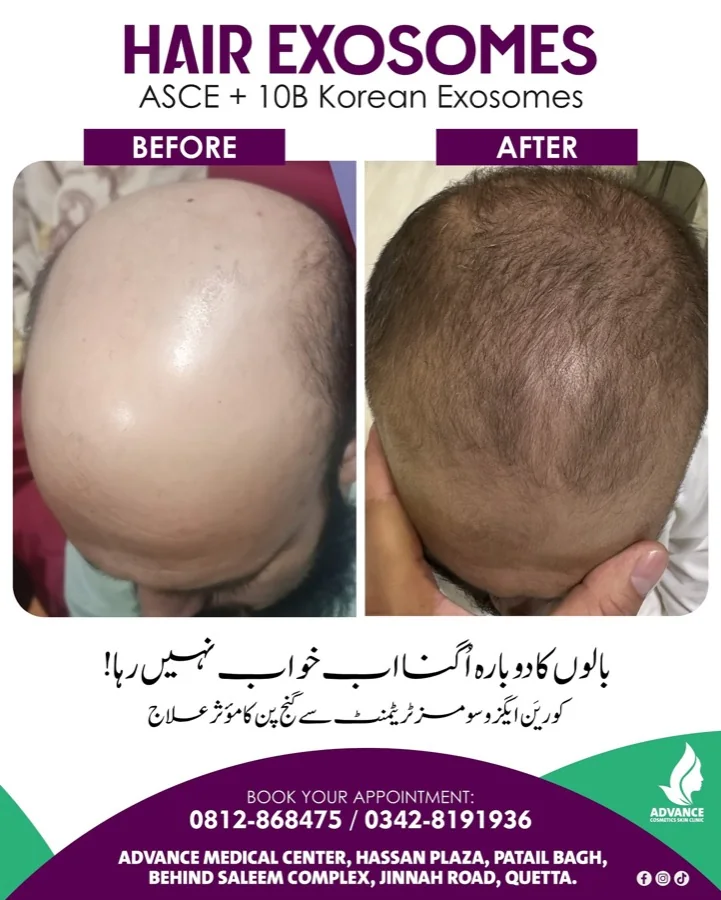 Hair fall and hair restoration