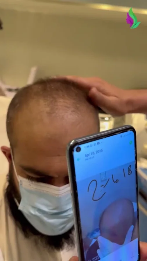 Hair fall and hair restoration