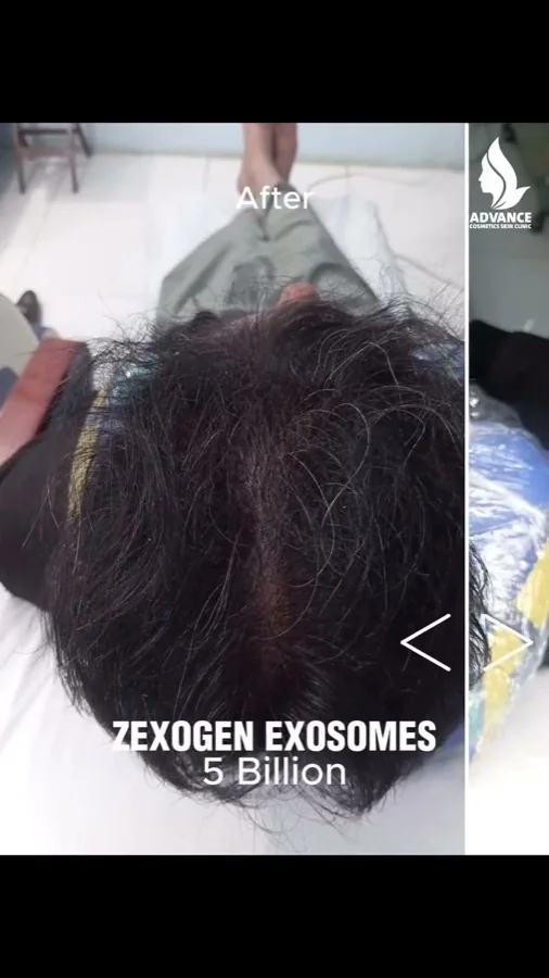 Hair fall and hair restoration