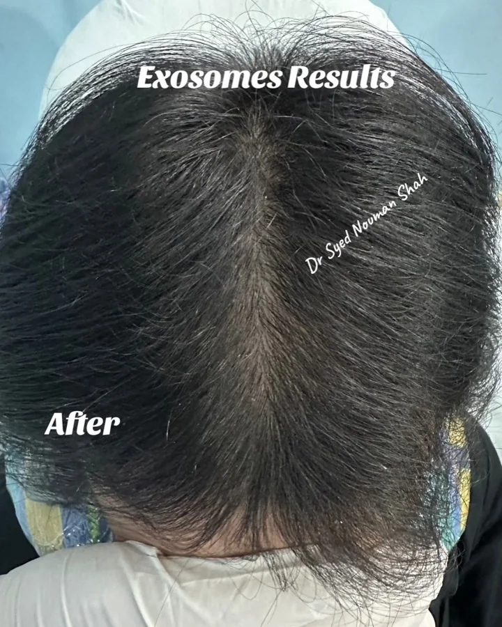 Hair fall and hair restoration