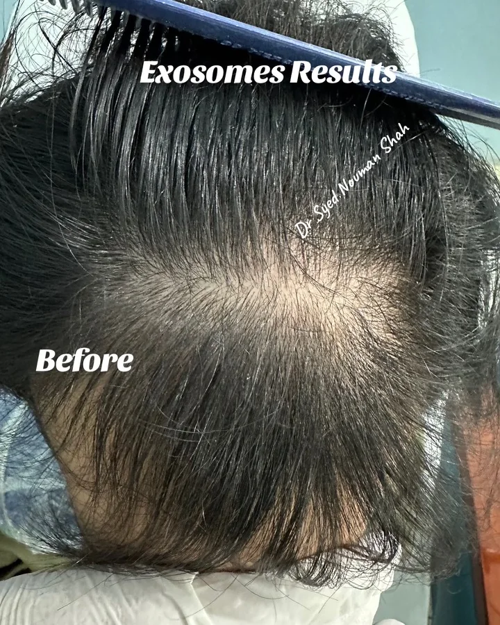 Hair fall and hair restoration