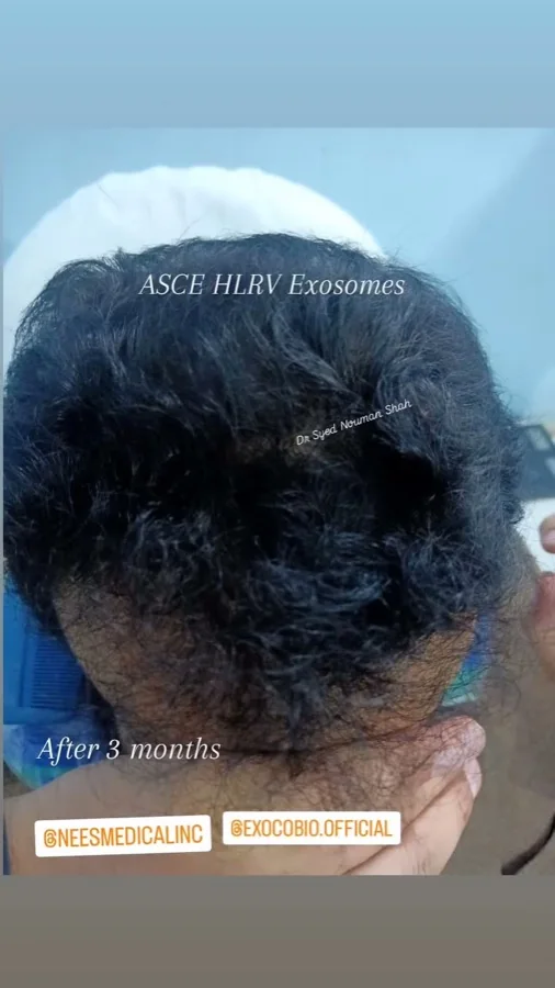 Hair fall and hair restoration