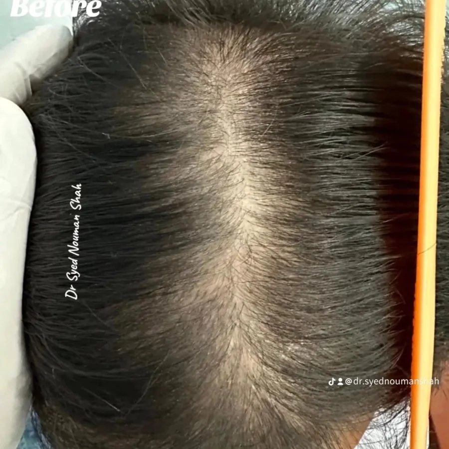 Hair fall and hair restoration