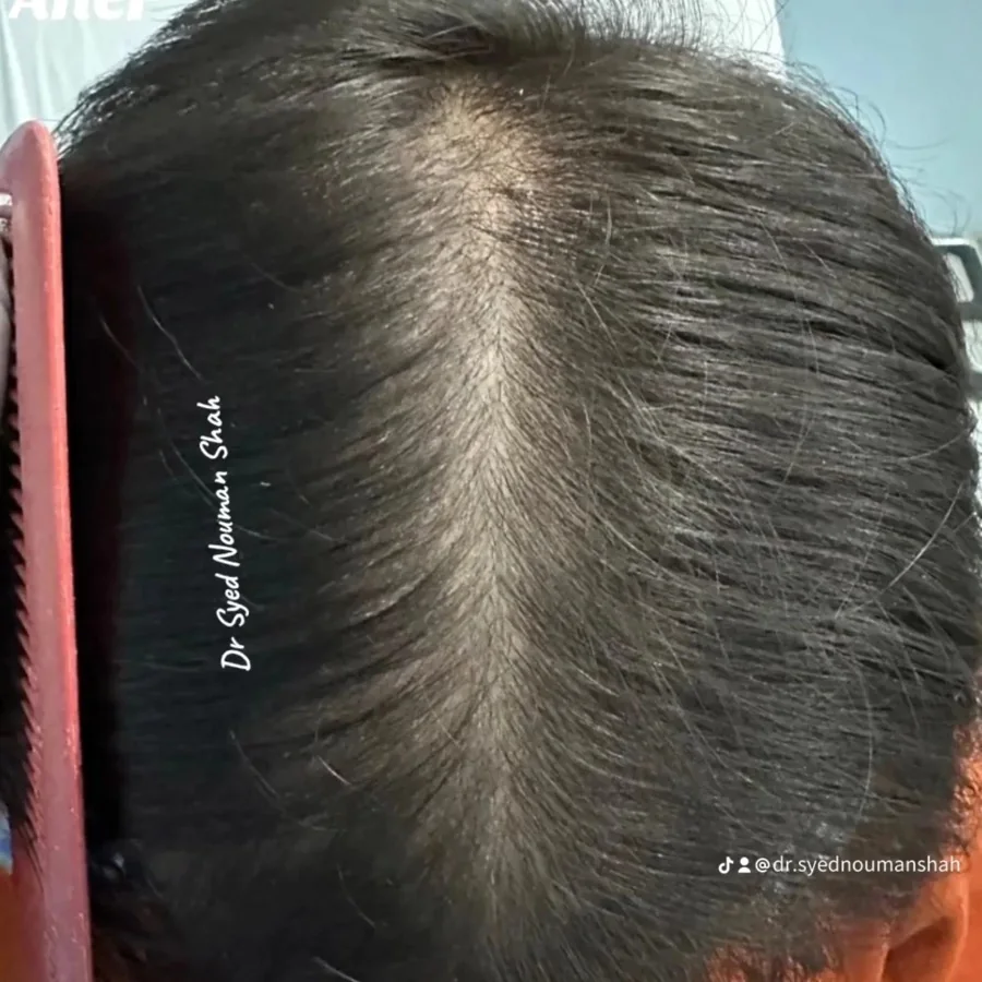 Hair fall and hair restoration