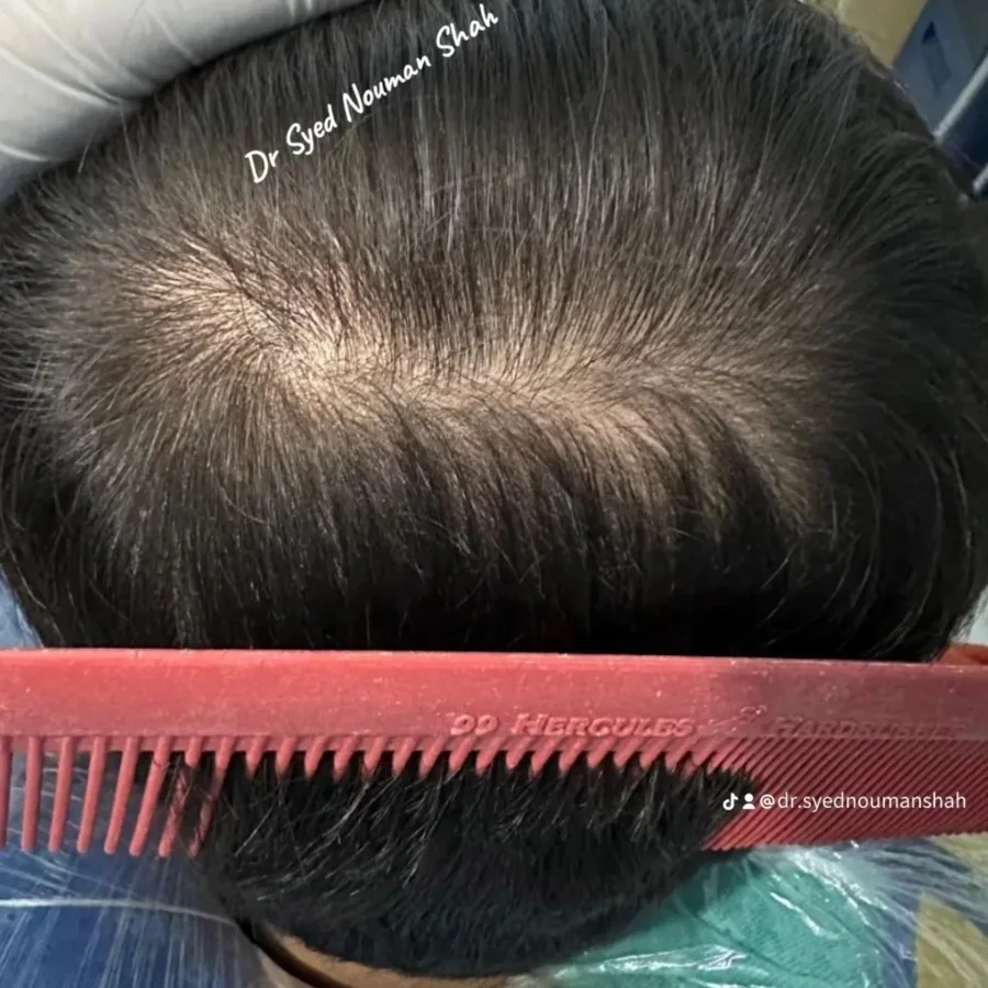 Hair fall and hair restoration