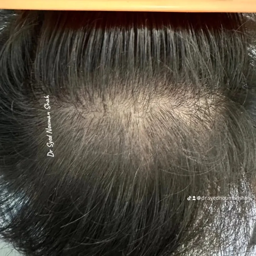 Hair fall and hair restoration